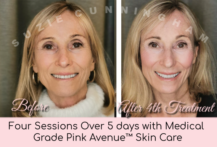 Best Micro Current Facial, Pink Avenue, Toronto, ON Canada